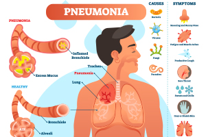 Pneumonia - Causes and Symptoms